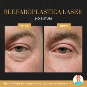 Blefaroplastica laser Roma, prima e dopo l'intervento