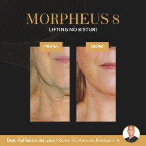Morpheus 8 Roma: Lifting no bisturi