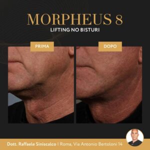 Morpheus 8 Roma: Lifting no bisturi